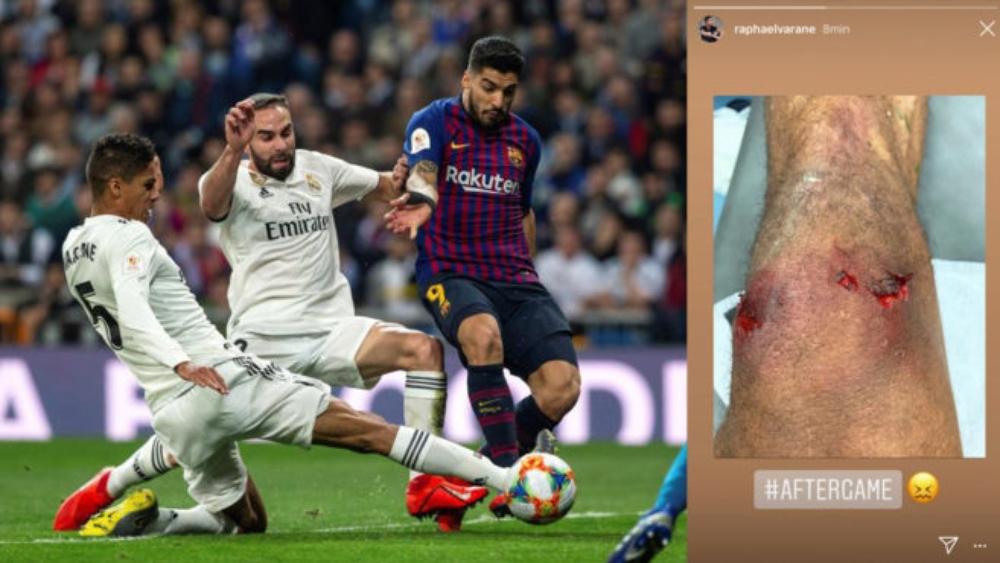 فاران أكمل الكلاسيكو بركبة مجروحة بعد هدفه العكسي