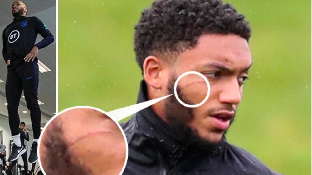 جو جوميز يظهر في التدريبات بجرح في وجهه نتيجة شجاره مع ستيرلينج