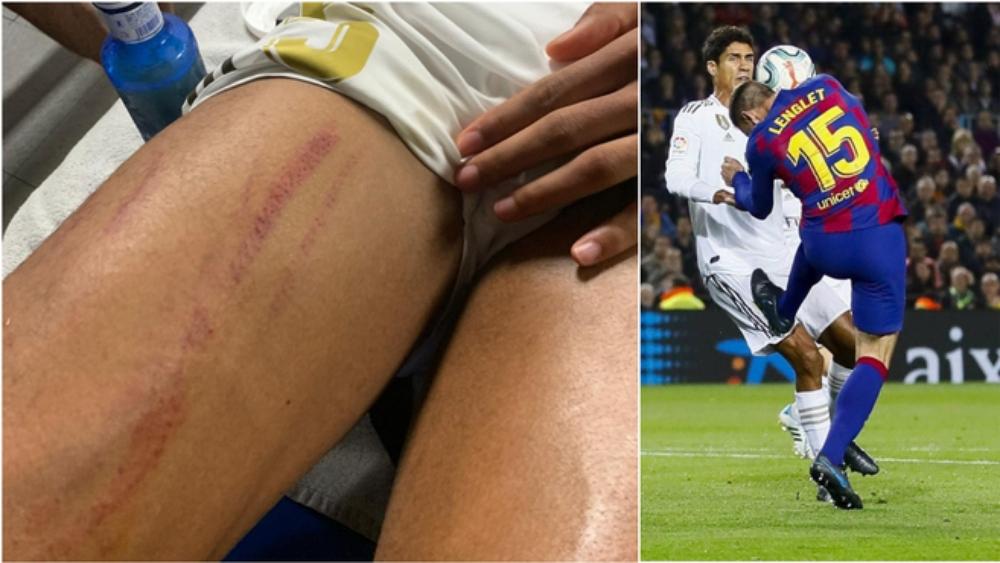 بالصور.. شاهد فخذ فاران بعد التدخل "القوي" للونغلي دون أن يعلن الحكم عن ركلة جزاء