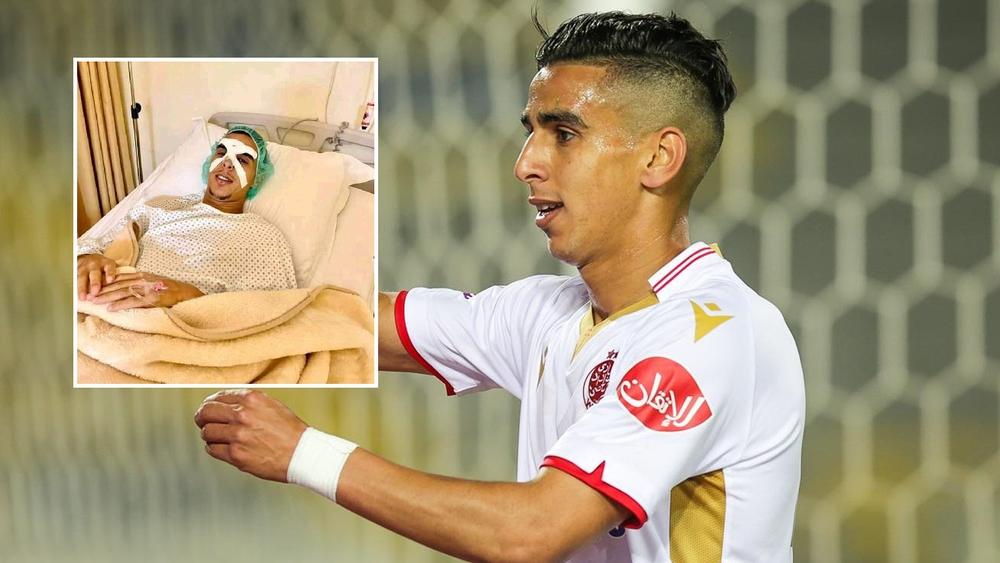 اللافي يجري عملية جراحية على مستوى الأنف واللاعب لن يغيب طويلا عن الوداد مع إمكانية استعمال "واقي الوجه"