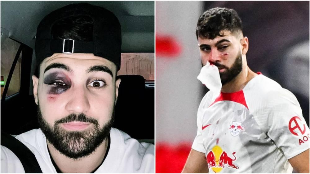 مدافع كرواتيا "جيفارديول" يتعرض لكسر في الأنف وإصابة قوية في العين ومشاركته أمام المغرب تبقى "واردة"